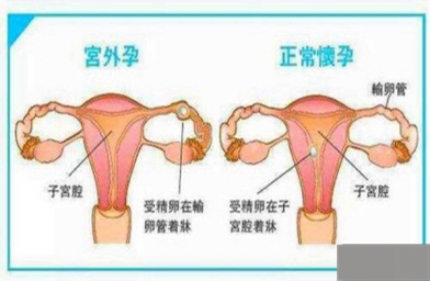 多囊女性进行试管婴儿时好处还是坏处